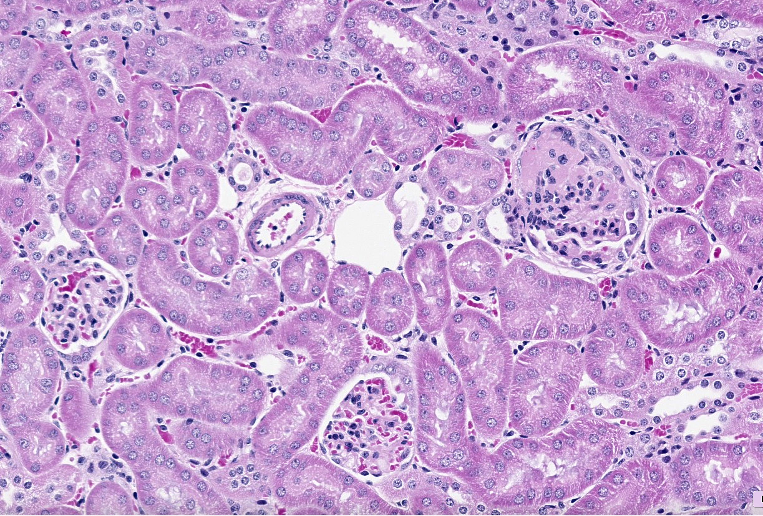 HE-stained glomerulus showing basement membrane changes